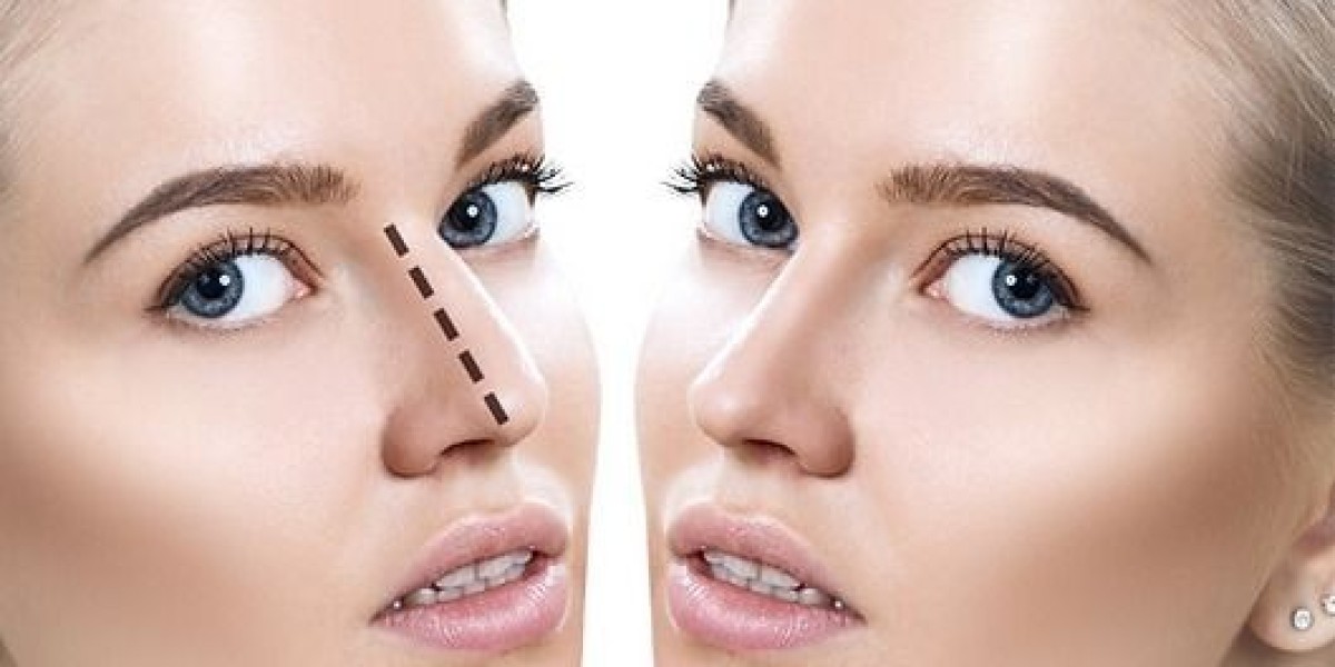 Rhinoplasty Dubai Price Insights for First-Time Patients