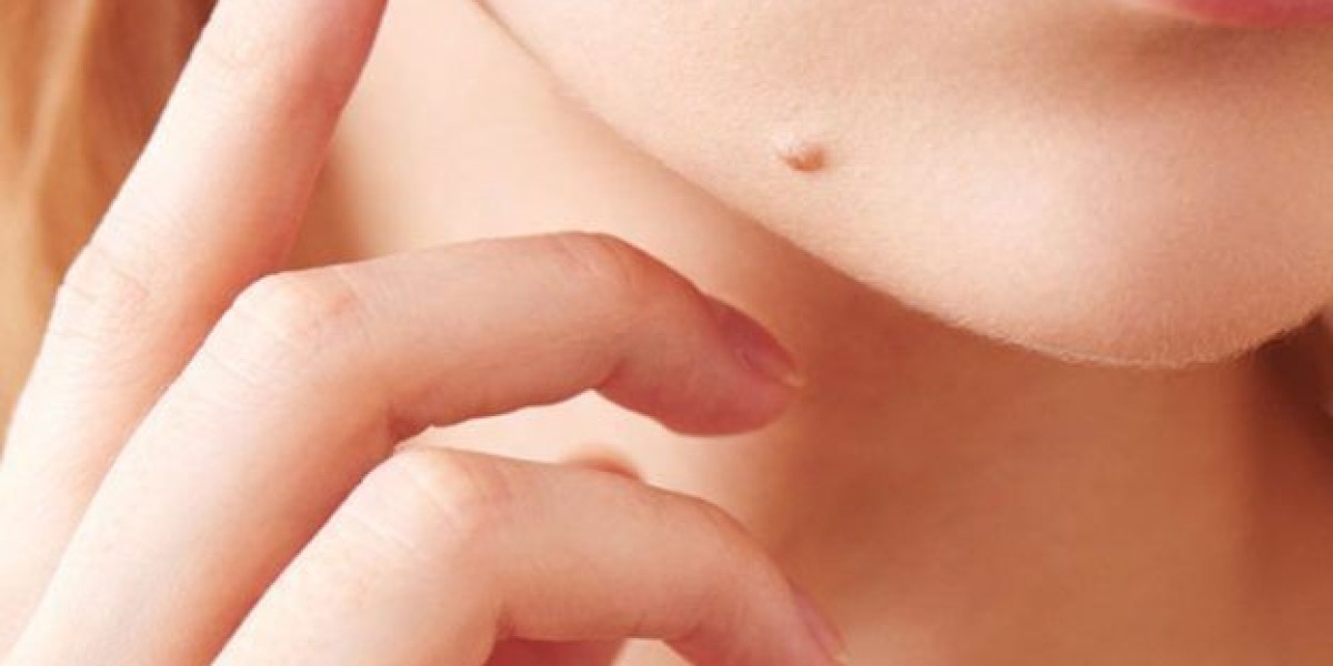 Mole removal in Dubai: Managing High-Friction and Body Moles