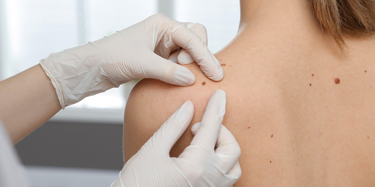 Does Benign Mole Removal Leave Scars?