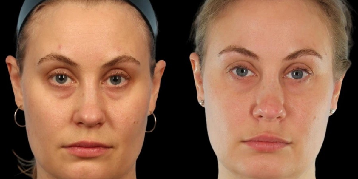 Under Eye Fillers Treatments in Dubai Maximum Comfort