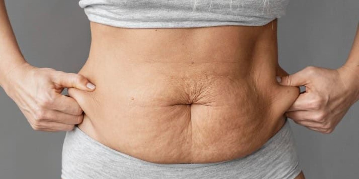 Mini Tummy Tuck Dubai: Recovery Tips for Best Results