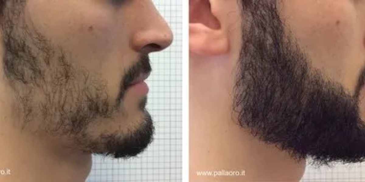 Beard hair transplant in Dubai: Solving thin mustache problems