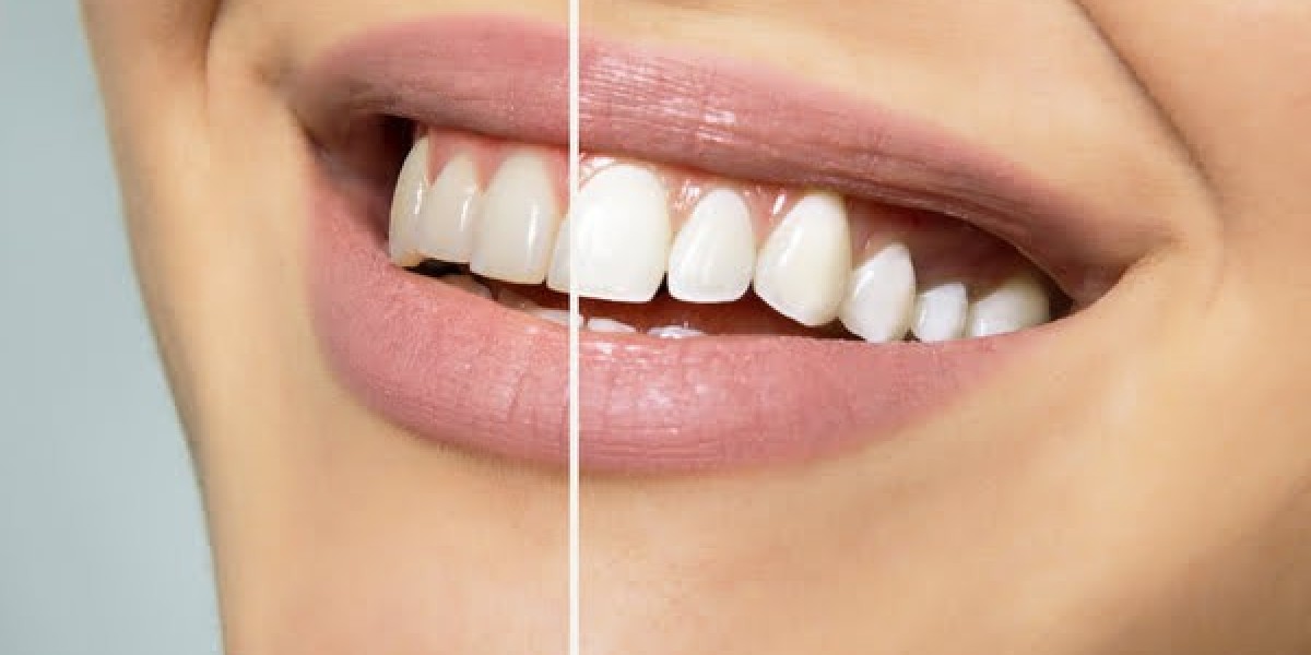 The Complete Guide to Professional Tooth Cleaning in Pune: Costs, Procedure & Benefits