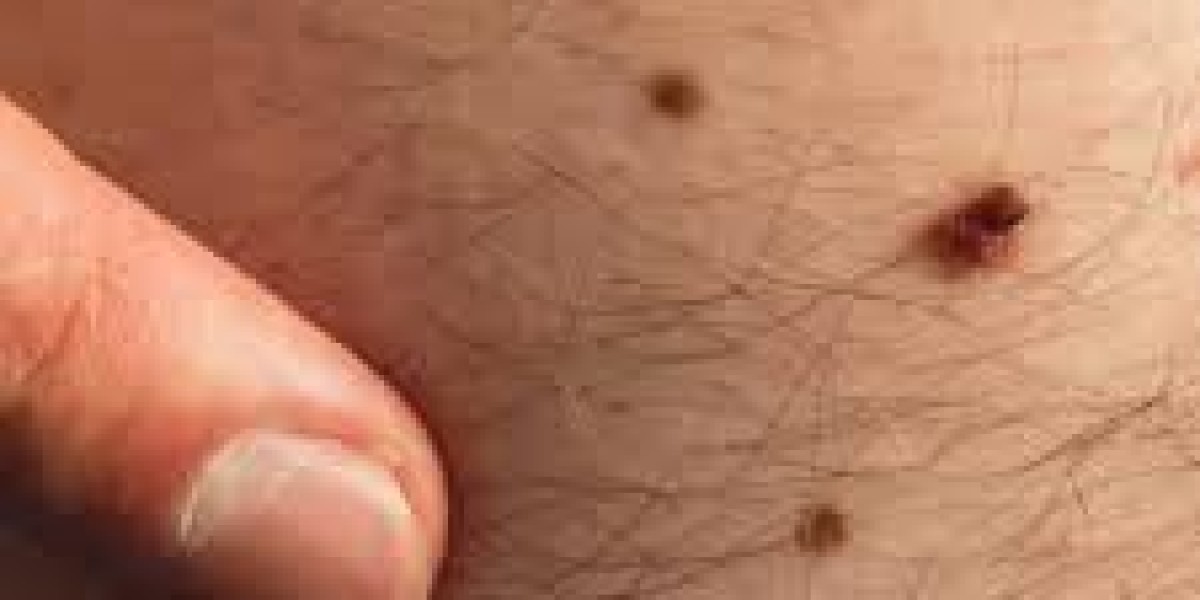 Does Mole Removal Cause Scarring?