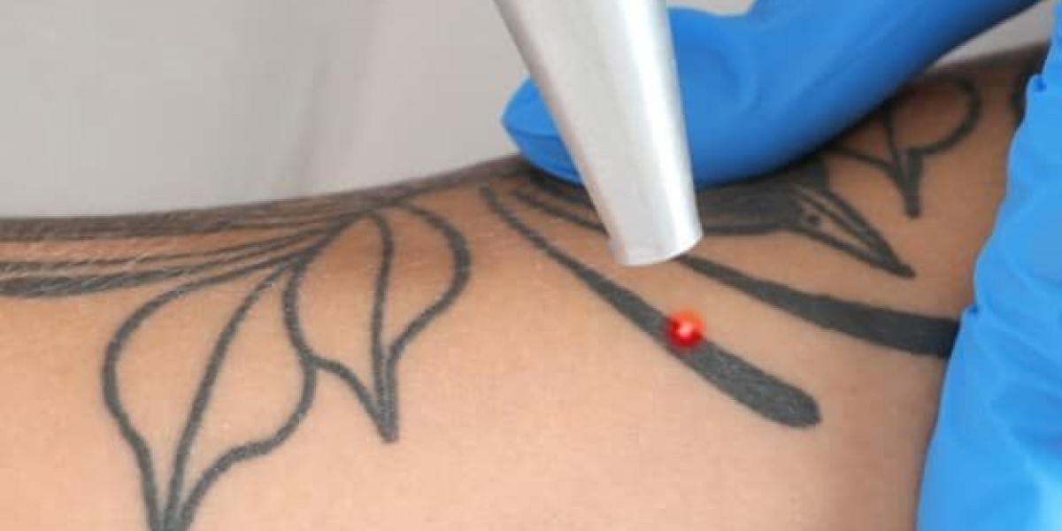 Tattoo Removal in Dubai: How Many Sessions Do You Really Need?