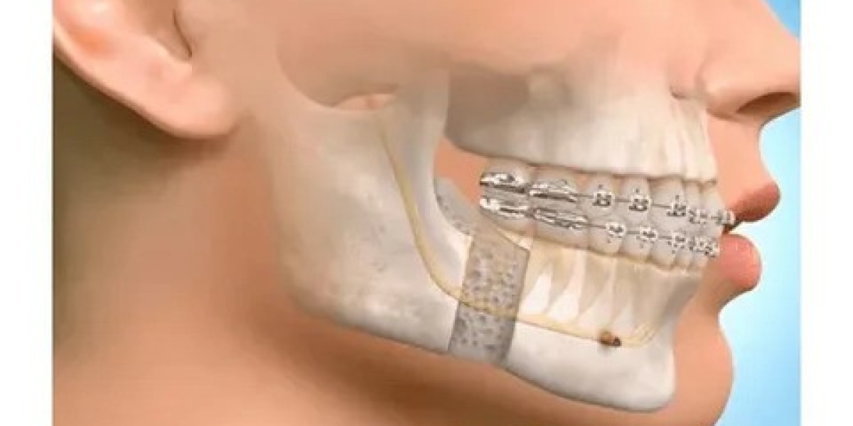 Jaw Surgery in Islamabad for TMJ and Bite Problems