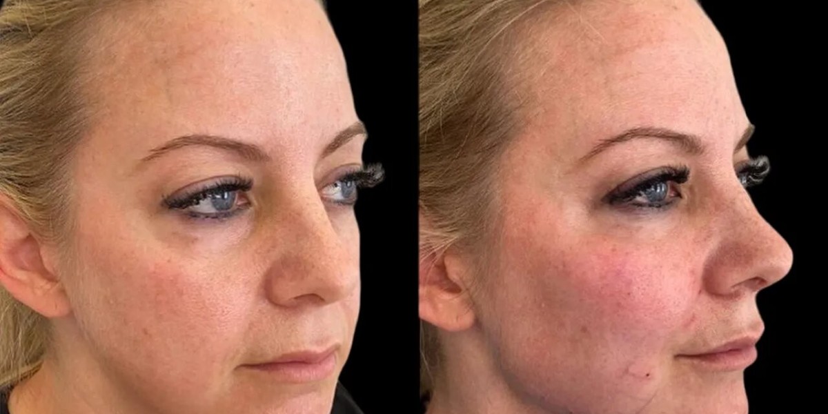 Cheek Fillers Treatments in Dubai What to Ask Before Treatment
