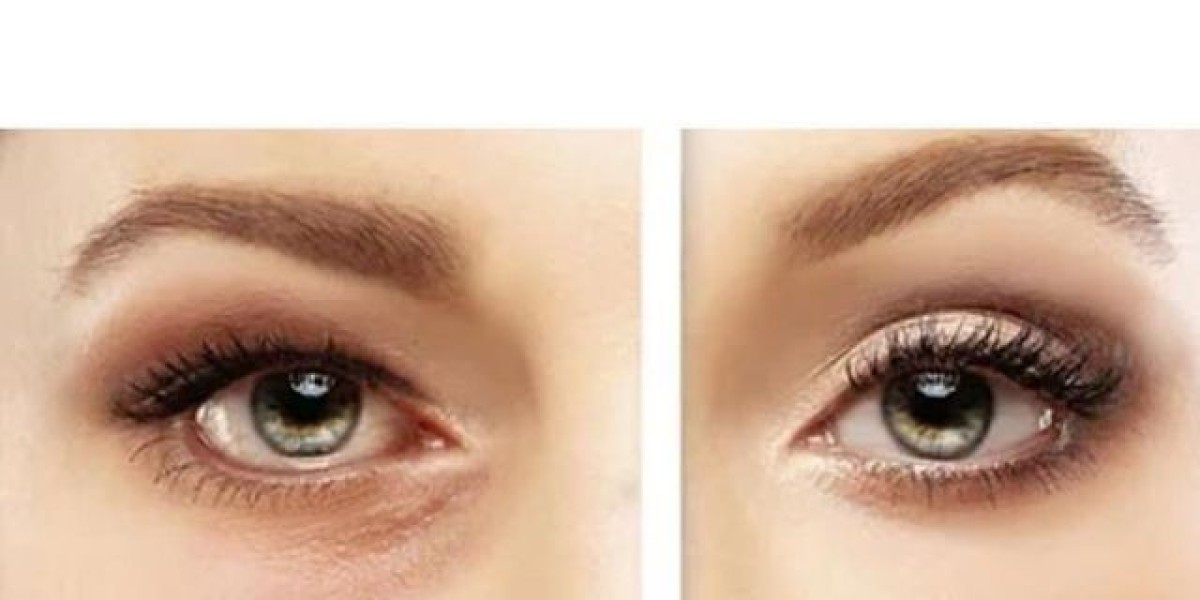 Ideal Age for Eyelid Surgery in Riyadh: Timing Your Transformation