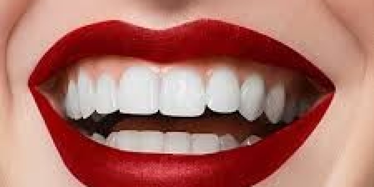 How Many Sessions Are Needed for Hollywood Smile Design?
