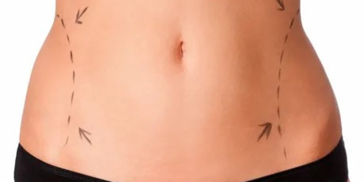 Liposuction in Dubai: Precision Fat Removal for a Sculpted Body