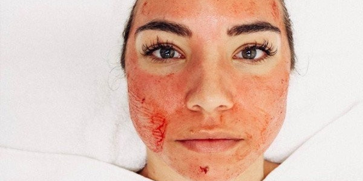 How Many Sessions Are Needed for Vampire Facial?