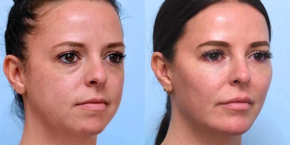 Enjoy Long-Lasting Youthful Glow With Thread lift treatments in Dubai