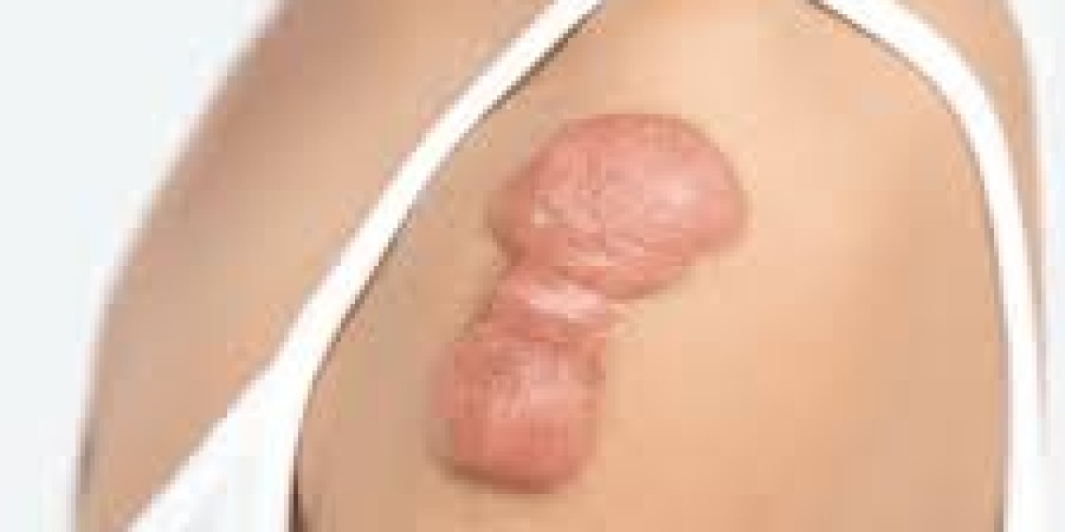 How Patients in Islamabad Found Relief from Keloid Treatment in Islamabad