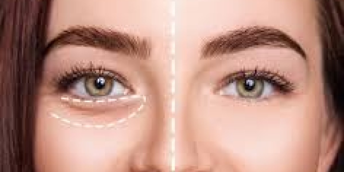 Best Hollow Under Eyes Treatment in Dubai: Cost, Results & Real Reviews