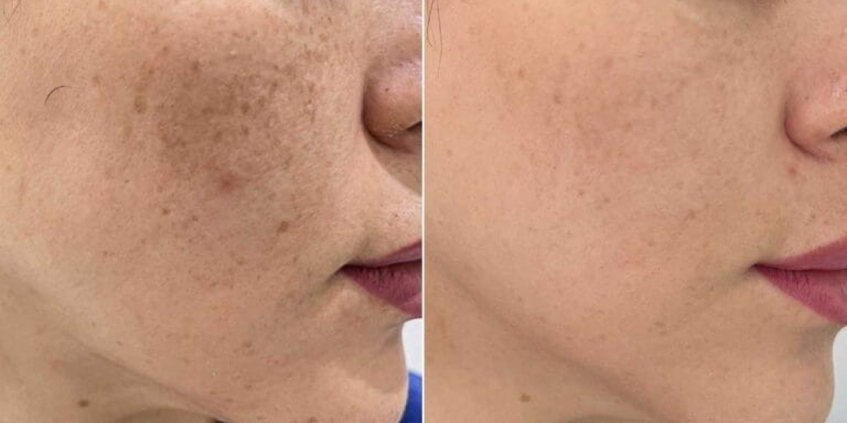 Laser Pigmentation Treatments in Dubai & Abu Dhabi – Glamorous Clinic Dubai