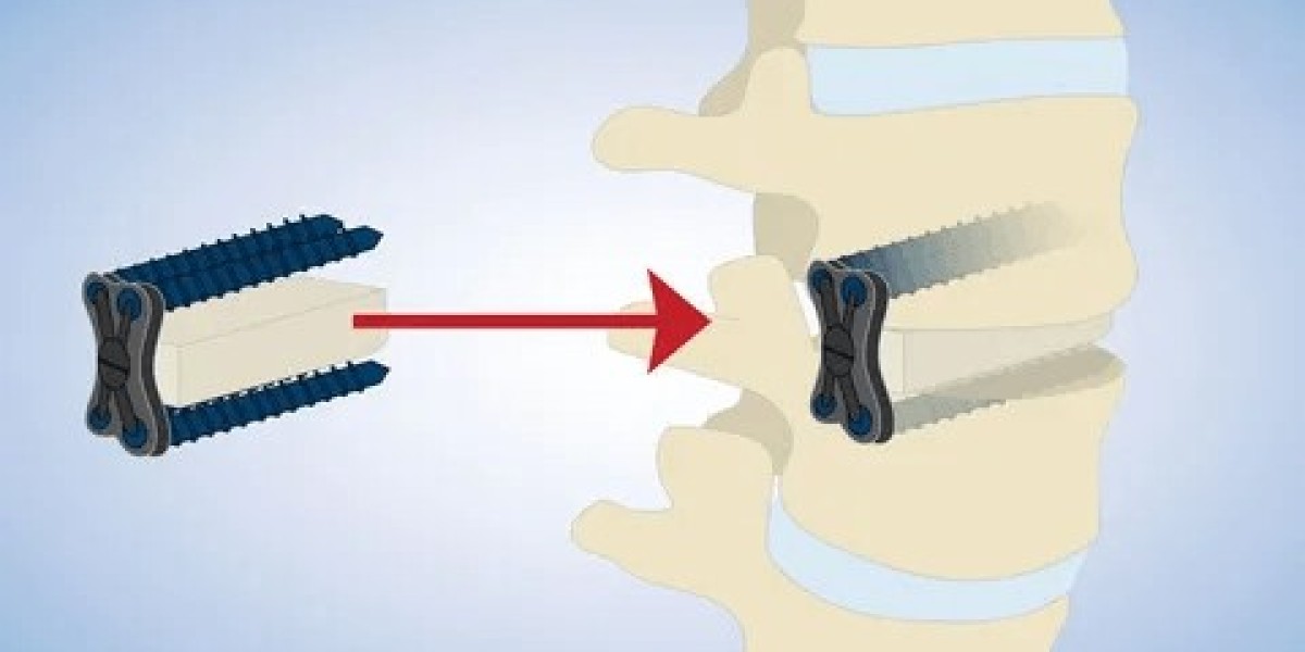 DLIF & XLIF Implants Market Size, Share & Forecast