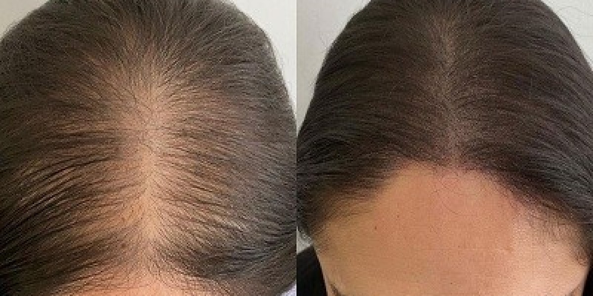PRP Hair Treatment in Dubai for Post-Chemotherapy Hair Loss