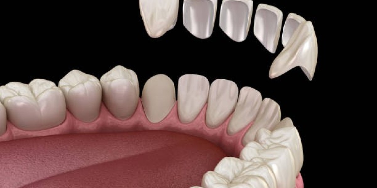 What Makes Perth a Top Destination for All-on-4 Implants?