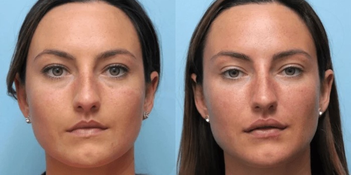 Best Plastic Surgeons in Dubai for Thread Lift with Precision and Expertise