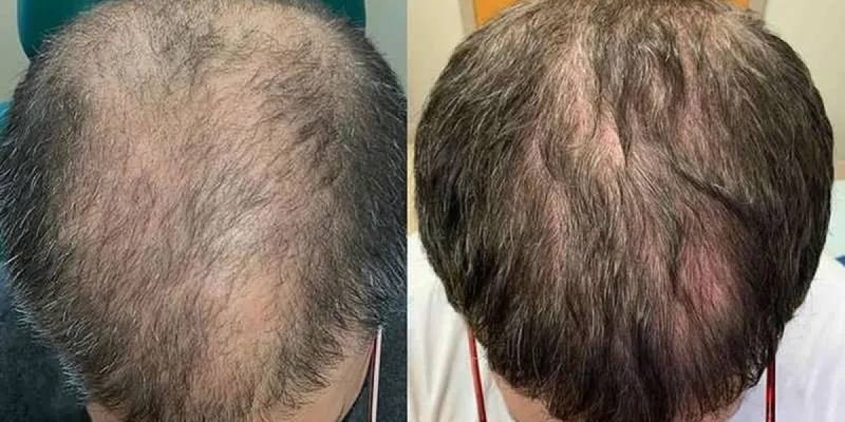 The Science of Scalp Regeneration A Guide to Exosome Treatments