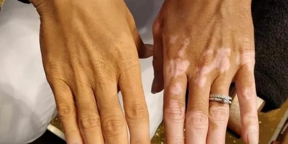 Medical Solutions for Vitiligo Treatment in Islamabad