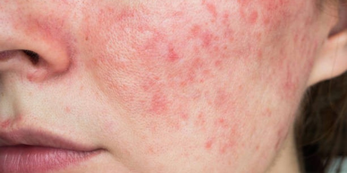 Enhance Skin Health with Laser Acne Therapy Basics