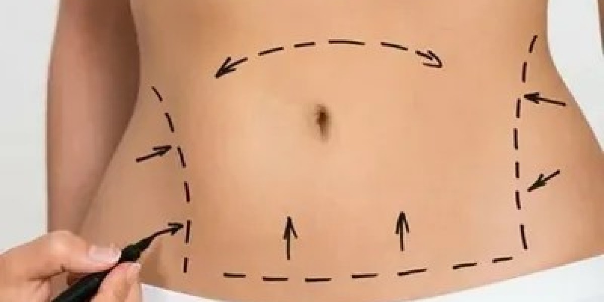 Liposuction in Dubai Abdomen: Achieve a Flatter, Sculpted Tummy