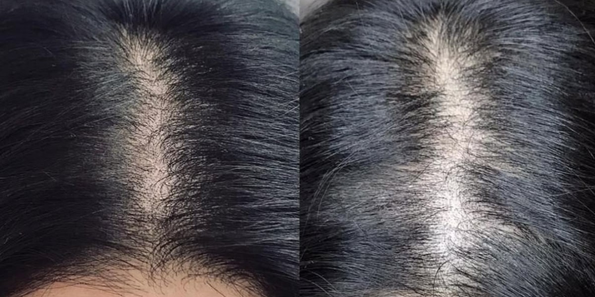 Hair Transplant in Dubai: A Comprehensive Look at Your Transformation