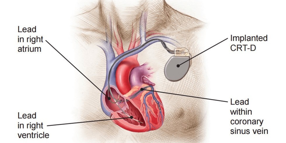Global Cardiac Bio Implant Devices Market Growth Analysis