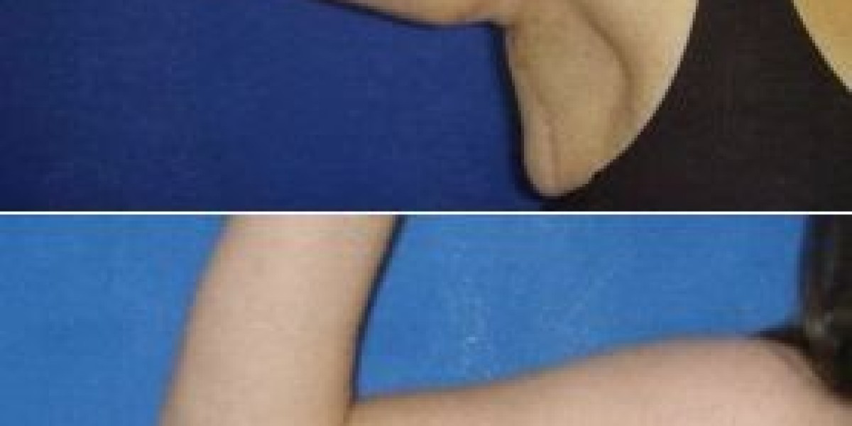 How Long Do Results Last After a Mini Tummy Tuck in Dubai?