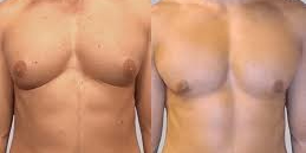 Non-Surgical Gynecomastia Treatments Available in Islamabad: Which Works Better