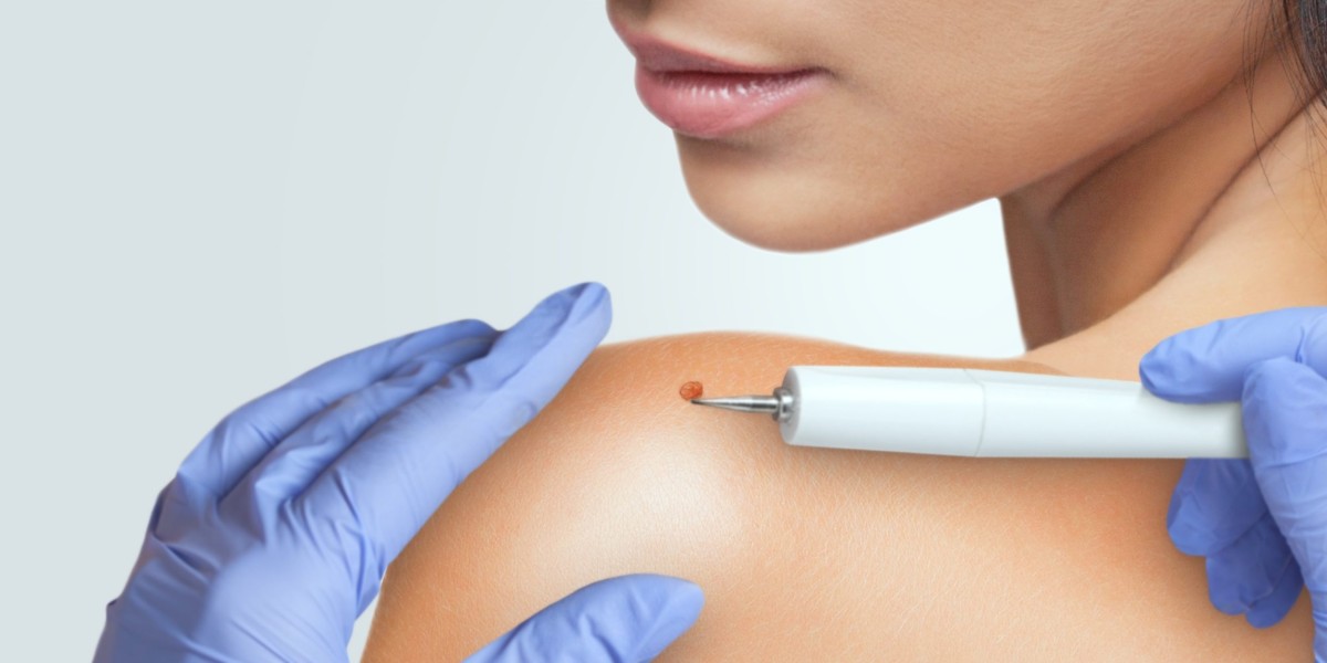 How Fast Is Professional Skin Tag Removal in Dubai?