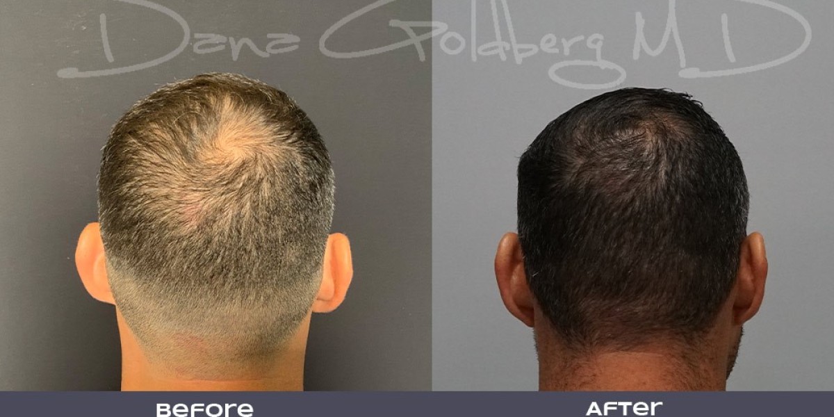 كل ما تحتاج معرفته عن زراعة الشعر في الرياض