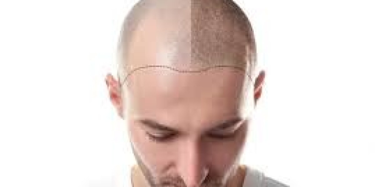 Islamabad’s Leading Hair Transplant Surgeons You Should Know