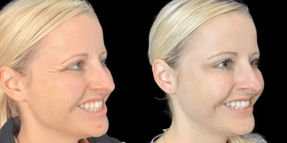 Best Doctors in Dubai for Botox for Fine Lines and Wrinkle Control