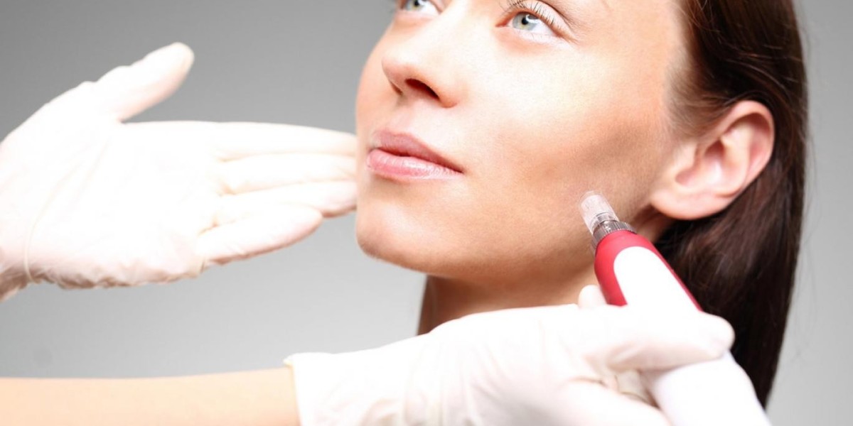 What Factors Influence Microneedling for Acne Scars?