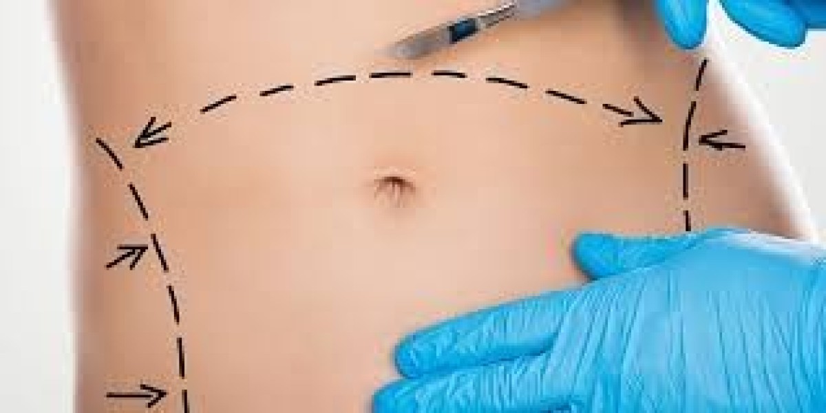Differences Between Abdominoplasty and Other Tummy Procedures in Dubai
