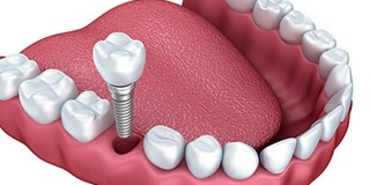 Perth Dental Implants: Innovative Techniques You Should Know