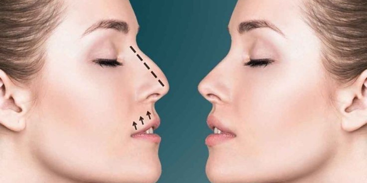 تجميل الأنف بمساعدة الكمبيوتر: رؤية نتيجتك قبل الجراحة