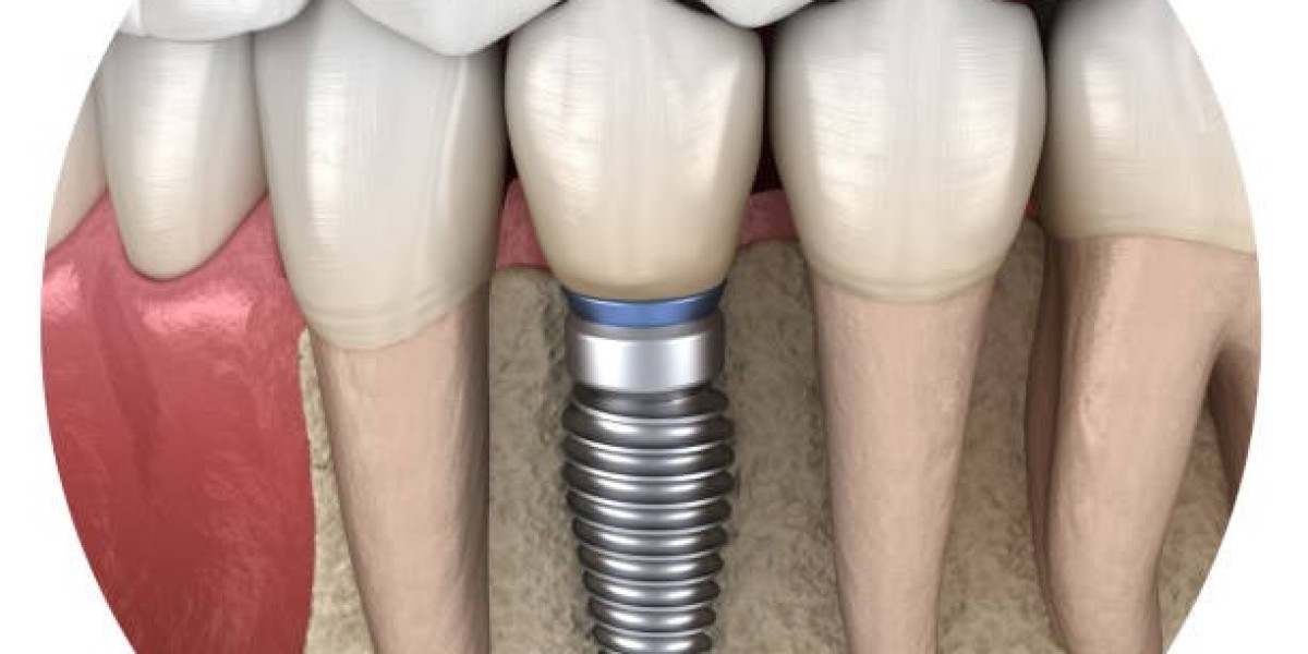 Real Factors Shaping Dental Implants Cost Today
