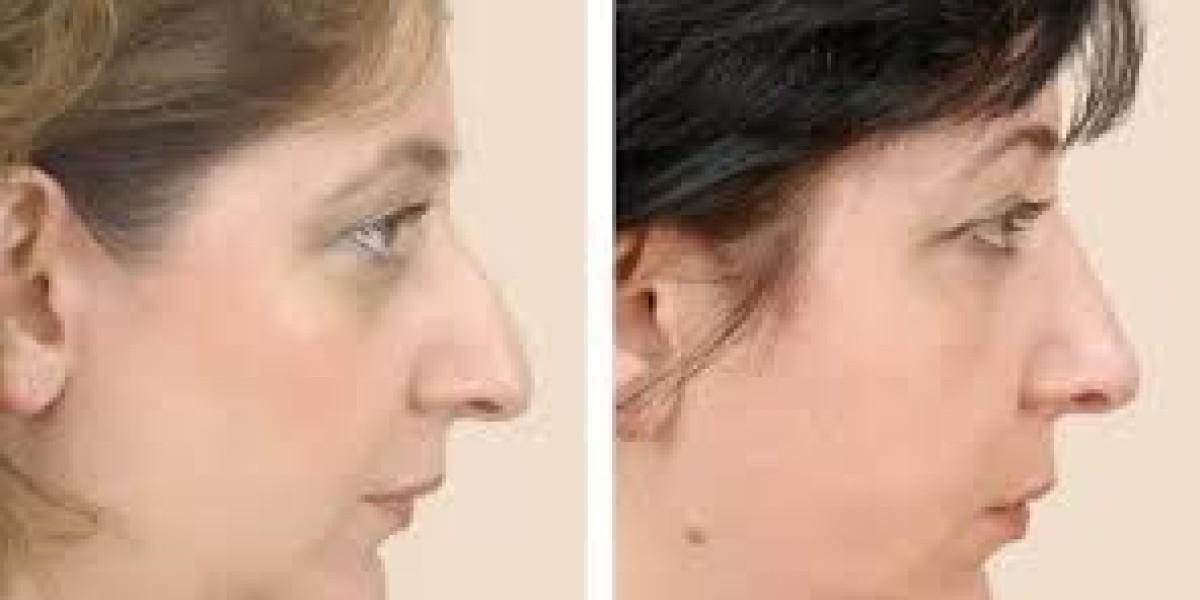 Top-Rated Nose Job Specialists in Dubai: What Makes Them Stand Out