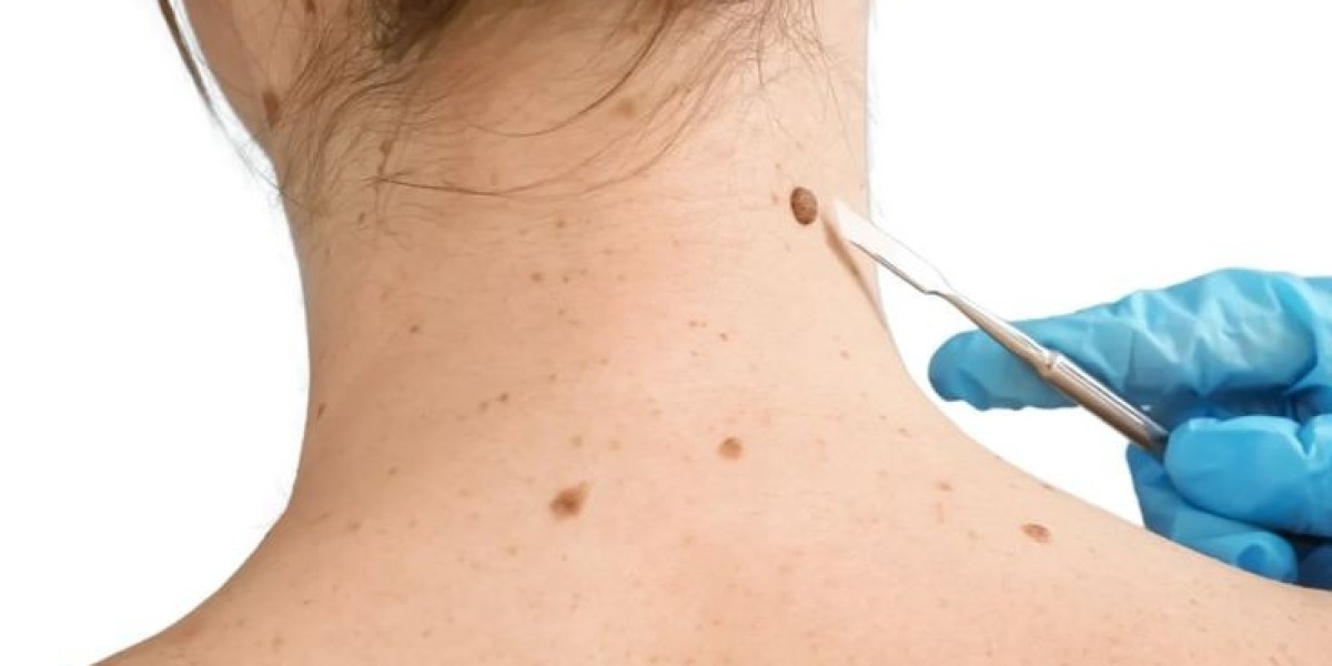 Mole removal in Dubai: Choosing the right care for you