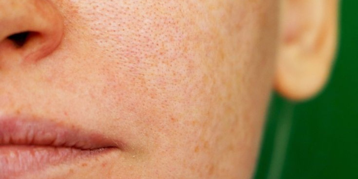 Pigmentation Treatment in Dubai: What to Expect Before and After Treatment