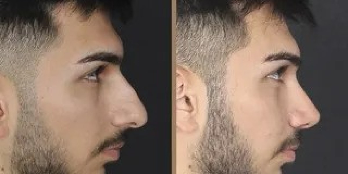 Best Rhinoplasty in Islamabad: Painless Procedures with Faster Recovery