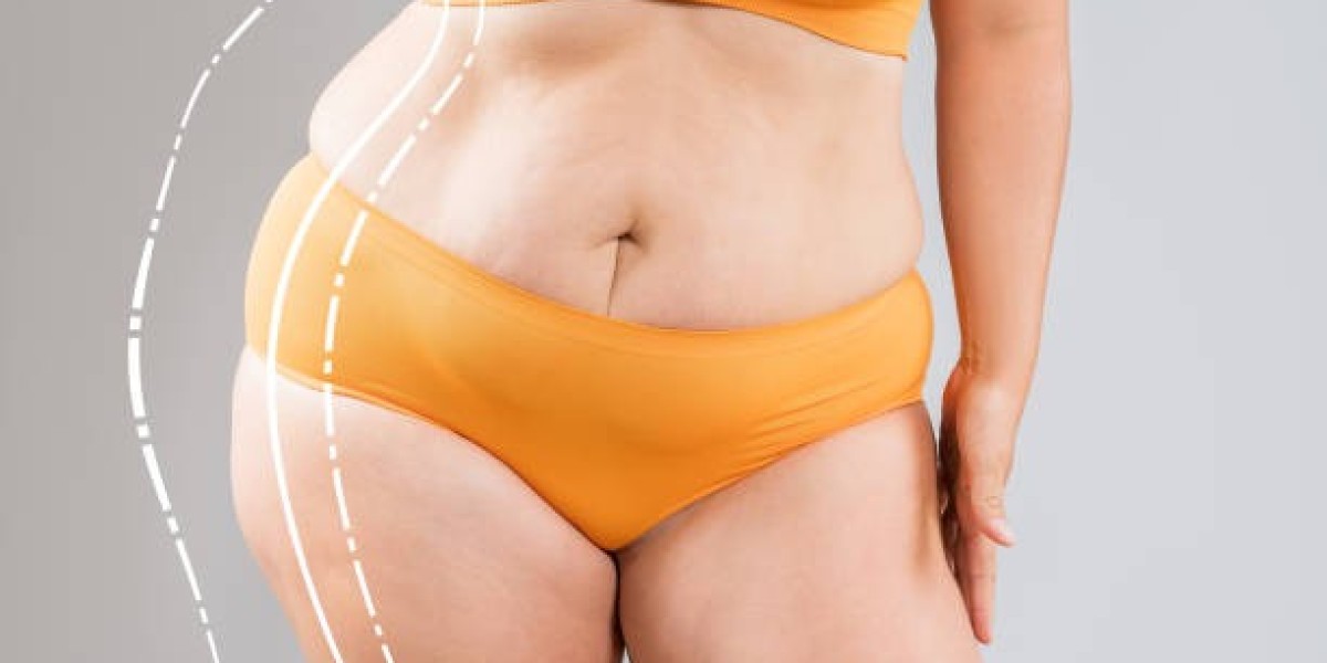 Vaser Quad Liposuction in Dubai: The Celebrity Secret to a Perfect Silhouette
