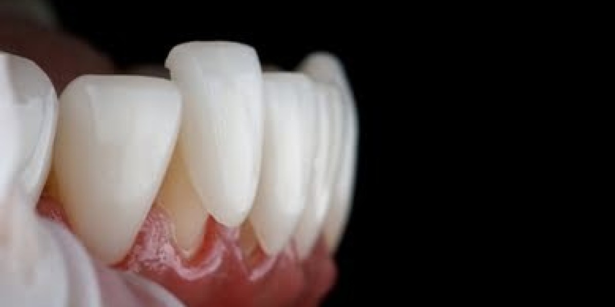 Dental Crowns in Pune: Your Complete Guide to Restoring Your Smile