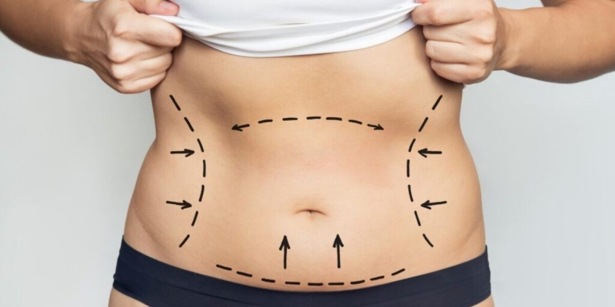 How Safe Is Liposuction? Key Facts Explained