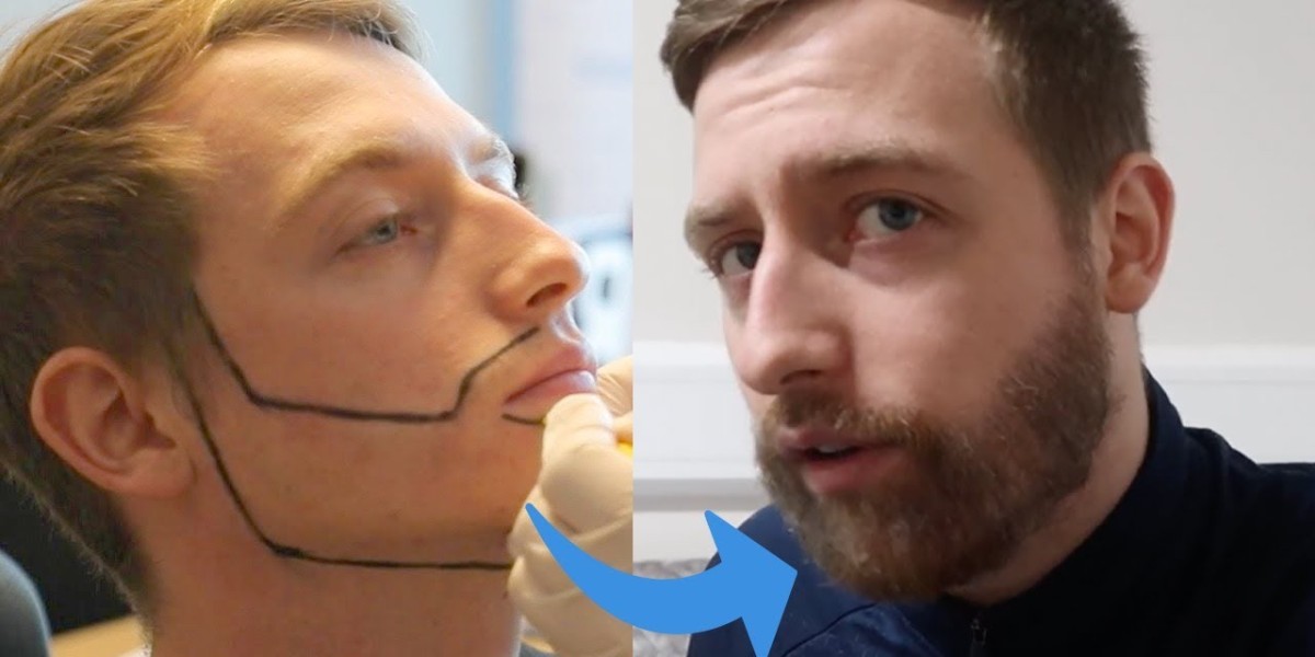زراعة شعر اللحية في الرياض لتحسين المظهر