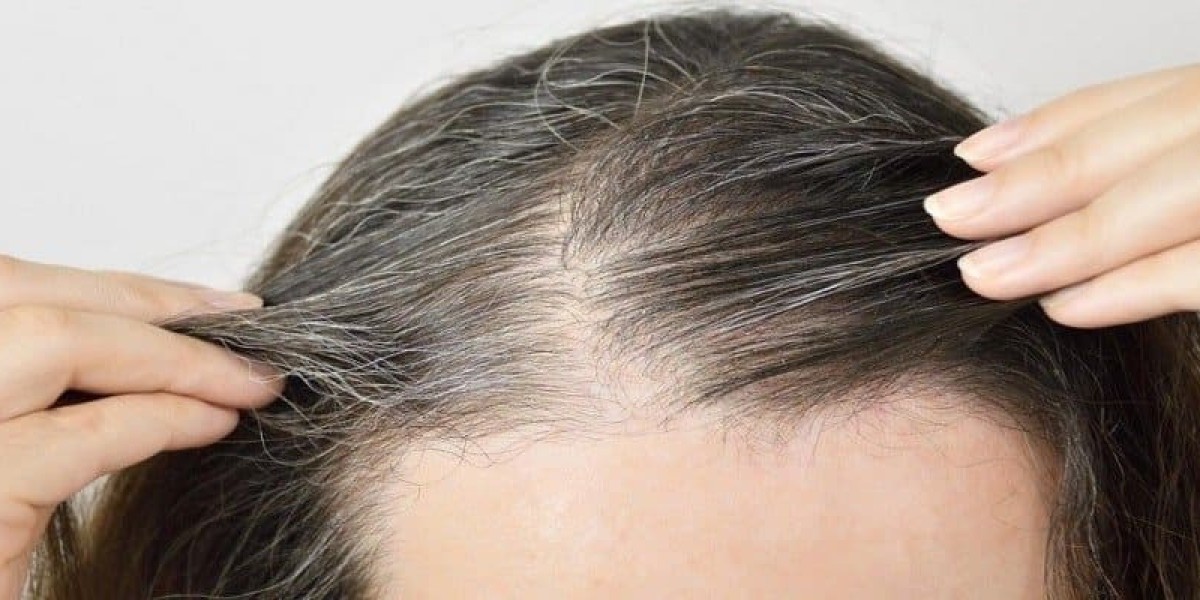 Can Female Hair Transplant Treat Female Pattern Baldness?