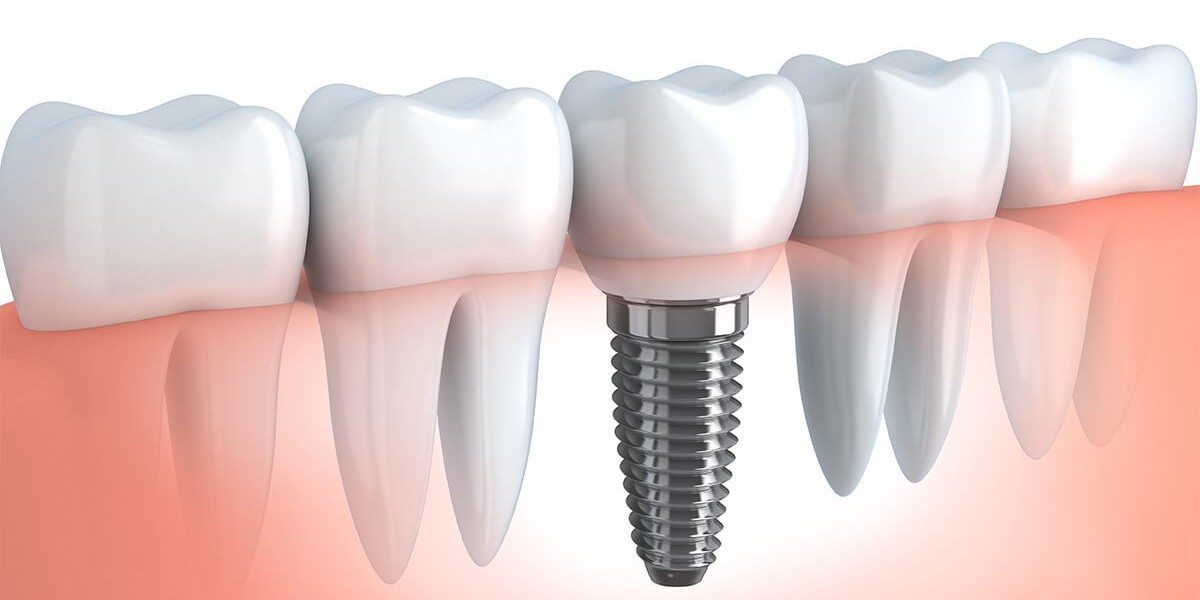 What Makes Dental Implants a Lifetime Solution?